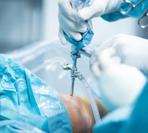 Arthroscopic Shoulder Surgery