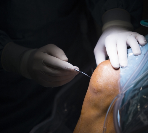 Arthroscopy