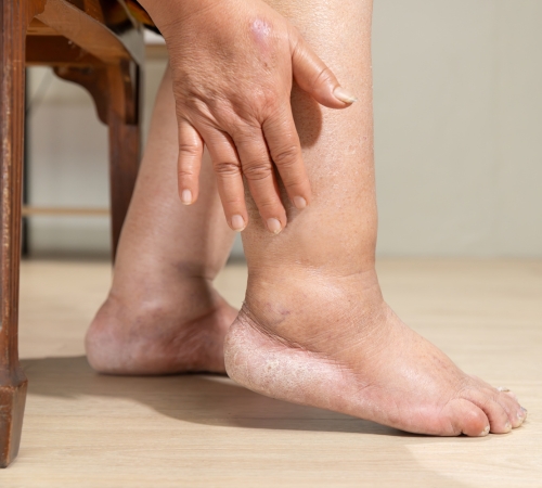 Chronic Ankle Instability