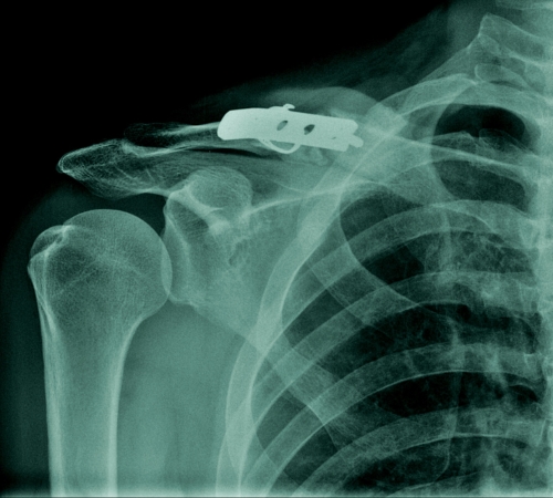 Fracture Fixation Surgery