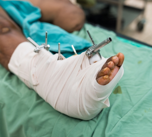 Fracture Fixation Surgery