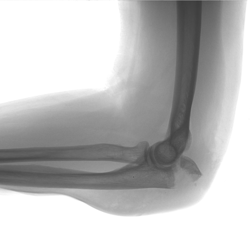 Fracture Fixation