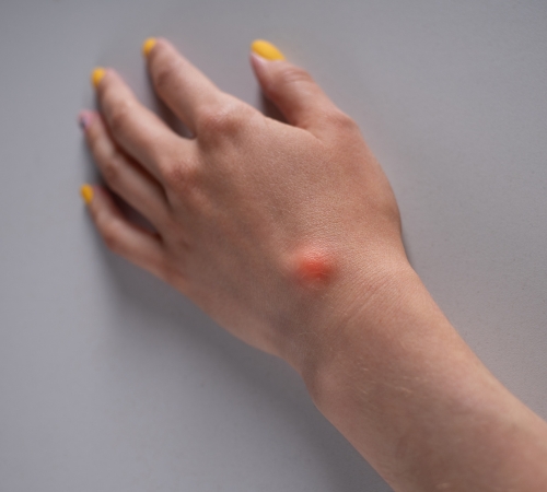 Ganglion Cyst