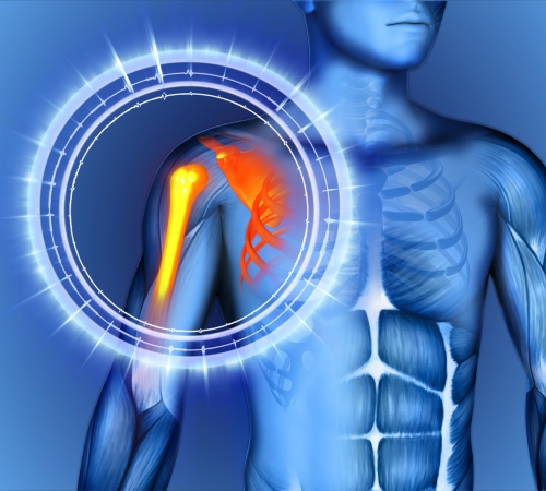 Revision & Corrective Shoulder Surgery