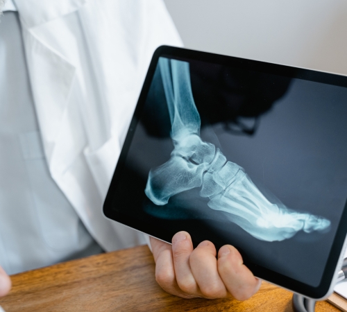 Total Ankle Replacement