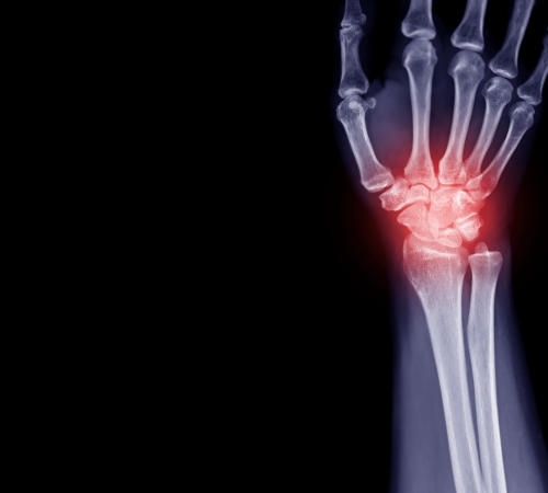 Wrist Joint Fusion